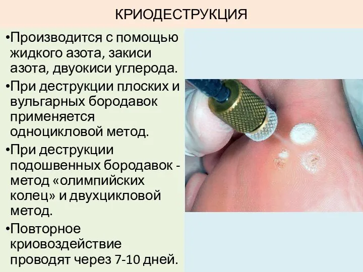 КРИОДЕСТРУКЦИЯ Производится с помощью жидкого азота, закиси азота, двуокиси углерода. При