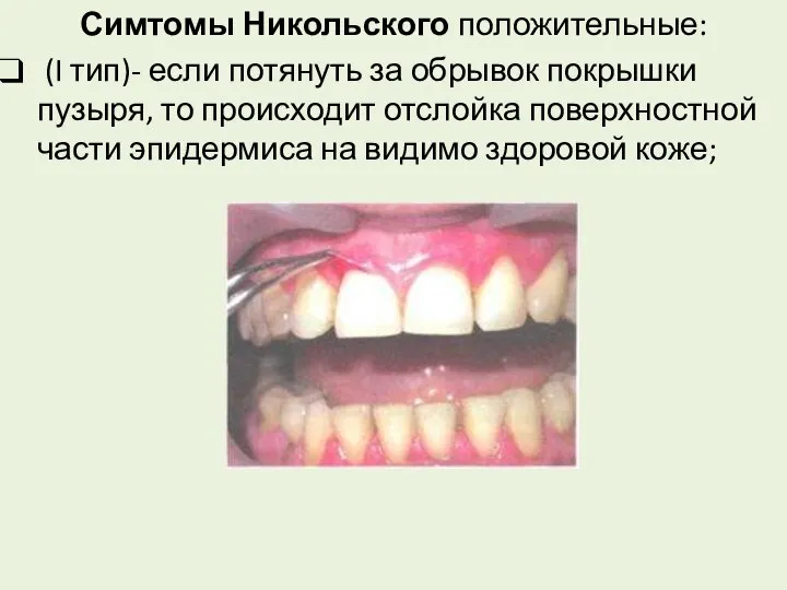 Симтомы Никольского положительные: (I тип)- если потянуть за обрывок покрышки пузыря,