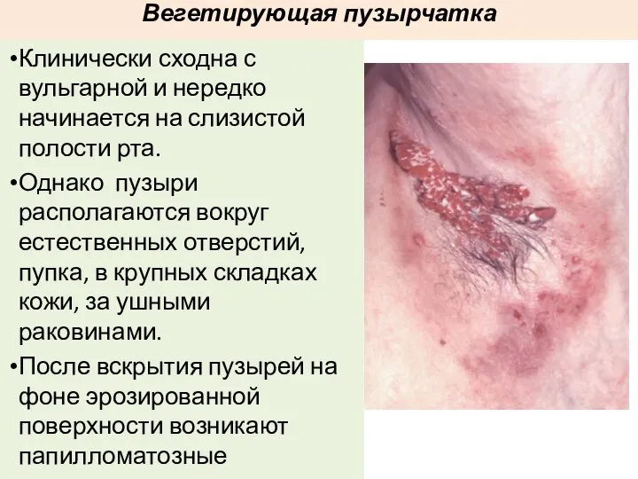 Вегетирующая пузырчатка Клинически сходна с вульгарной и нередко начинается на слизистой