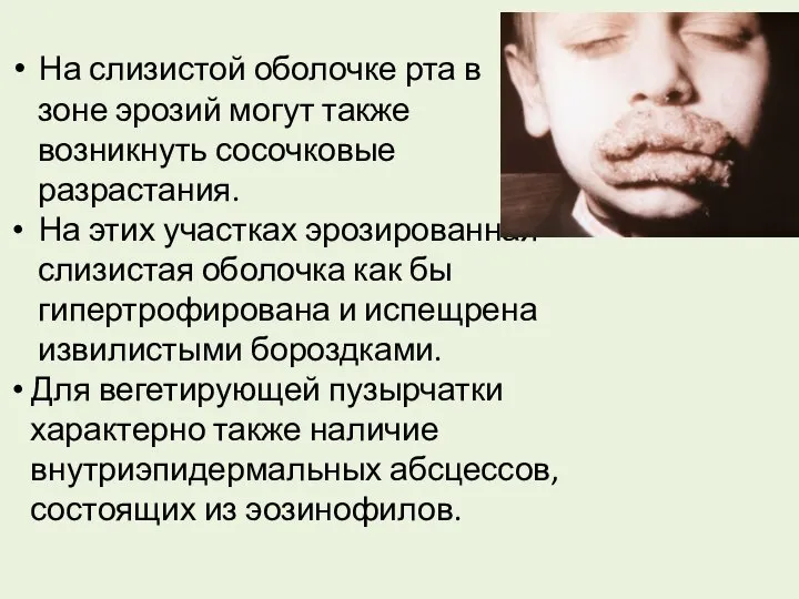 При вегетирующей пузырчатке на слизистой оболочке рта в зоне эрозий могут