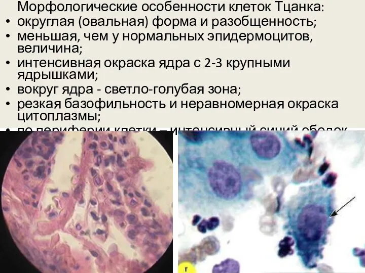 Морфологические особенности клеток Тцанка: округлая (овальная) форма и разобщенность; меньшая, чем