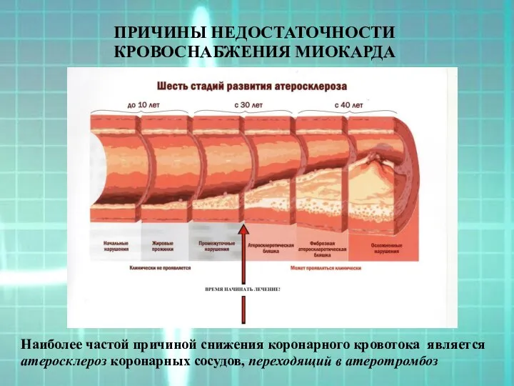 ПРИЧИНЫ НЕДОСТАТОЧНОСТИ КРОВОСНАБЖЕНИЯ МИОКАРДА Наиболее частой причиной снижения коронарного кровотока является