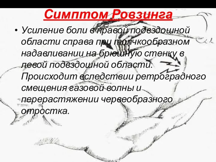 Симптом Ровзинга Усиление боли в правой подвздошной области справа при толчкообразном