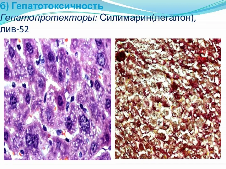 б) Гепатотоксичность Гепатопротекторы: Силимарин(легалон), лив-52