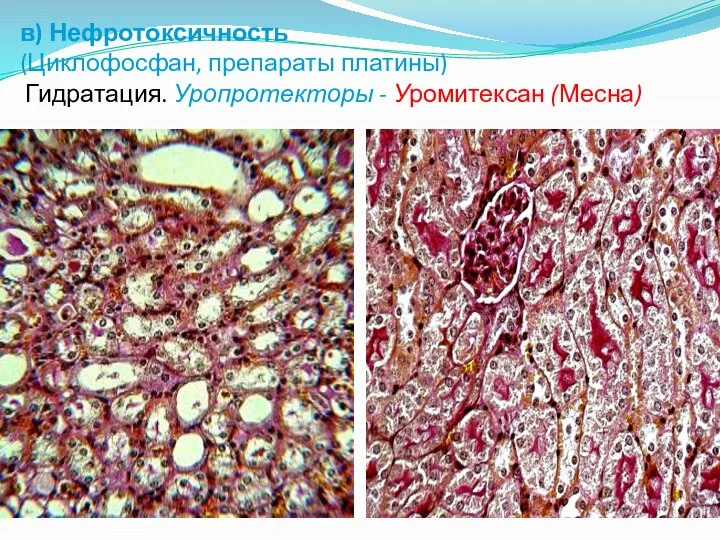 в) Нефротоксичность (Циклофосфан, препараты платины) Гидратация. Уропротекторы - Уромитексан (Месна)
