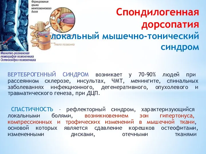 Спондилогенная дорсопатия - локальный мышечно-тонический син­дром ВЕРТЕБРОГЕННЫЙ СИНДРОМ возникает у 70-90%