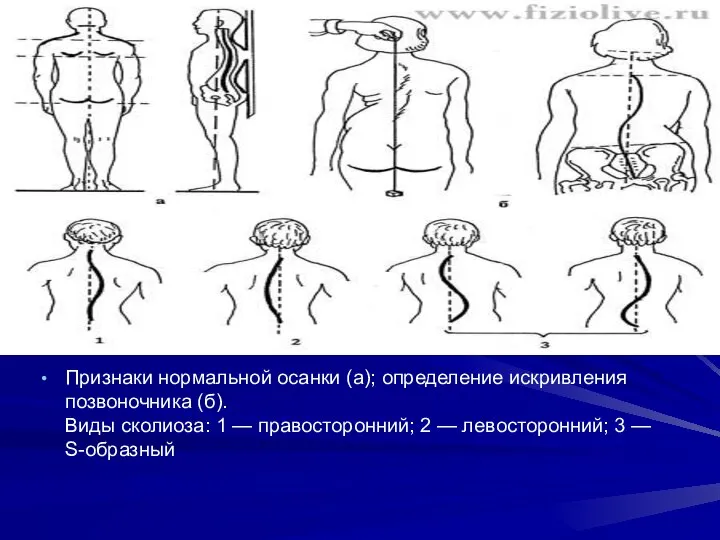 Признаки нормальной осанки (а); определение искривления позвоночника (б). Виды сколиоза: 1