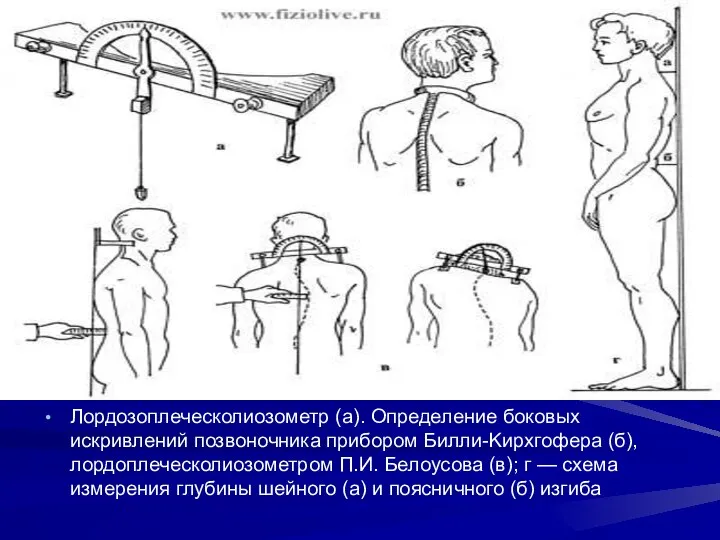 Лордозоплеческолиозометр (а). Определение боковых искривлений позвоночника прибором Билли-Kирхгофера (б), лордоплеческолиозометром П.И.