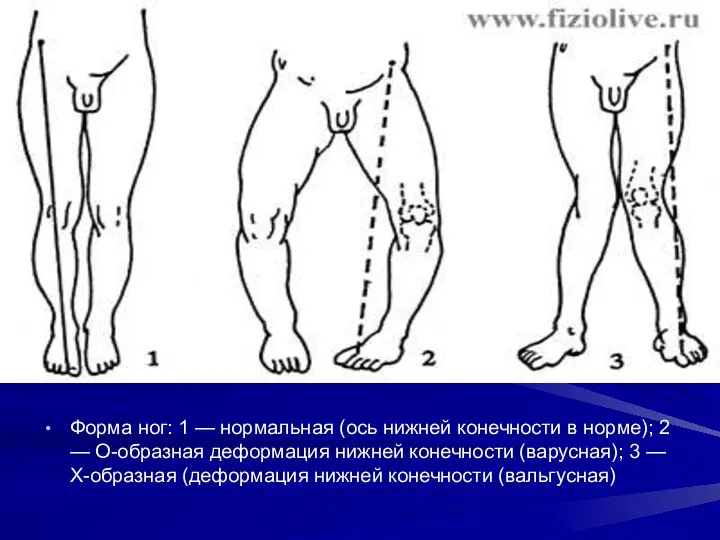 Форма ног: 1 — нормальная (ось нижней конечности в норме); 2