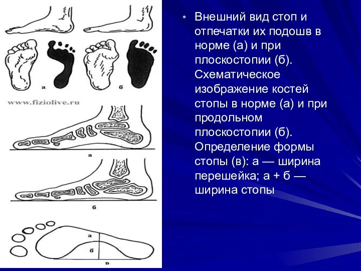 Внешний вид стоп и отпечатки их подошв в норме (а) и