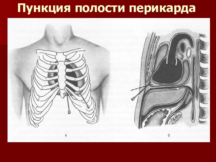 Пункция полости перикарда