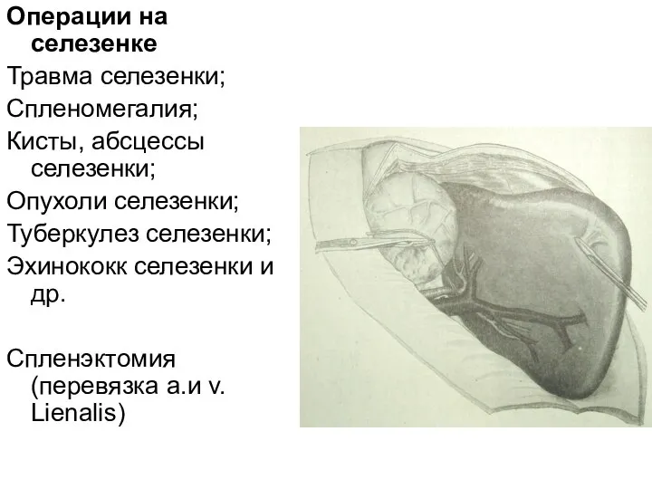 Операции на селезенке Травма селезенки; Спленомегалия; Кисты, абсцессы селезенки; Опухоли селезенки;