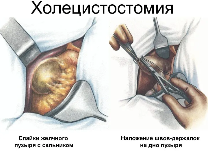 Холецистостомия Спайки желчного пузыря с сальником Наложение швов-держалок на дно пузыря