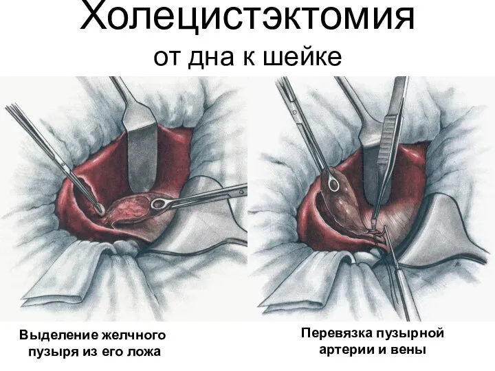 Холецистэктомия от дна к шейке Выделение желчного пузыря из его ложа Перевязка пузырной артерии и вены