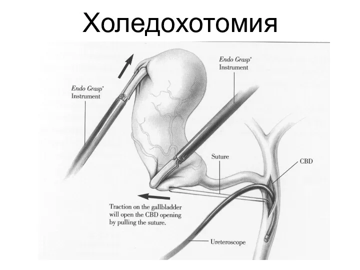 Холедохотомия