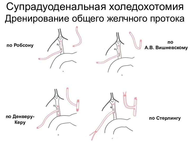 Супрадуоденальная холедохотомия Дренирование общего желчного протока по Робсону по А.В. Вишневскому по Денверу- Керу по Стерлингу