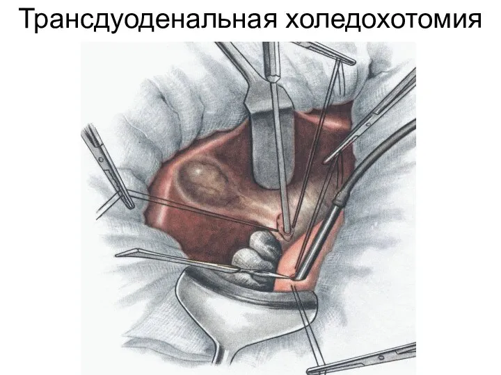 Трансдуоденальная холедохотомия