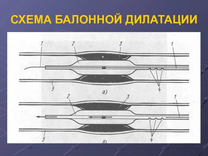 СХЕМА БАЛОННОЙ ДИЛАТАЦИИ