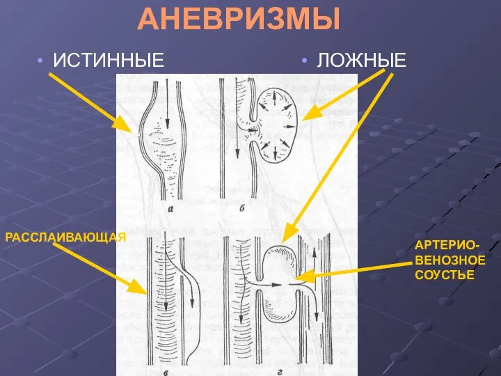 АНЕВРИЗМЫ ИСТИННЫЕ ЛОЖНЫЕ АРТЕРИО-ВЕНОЗНОЕ СОУСТЬЕ РАССЛАИВАЮЩАЯ