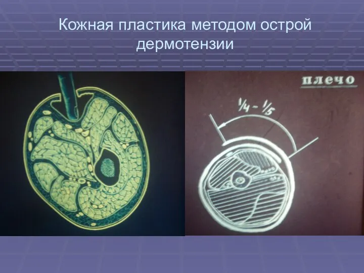 Кожная пластика методом острой дермотензии