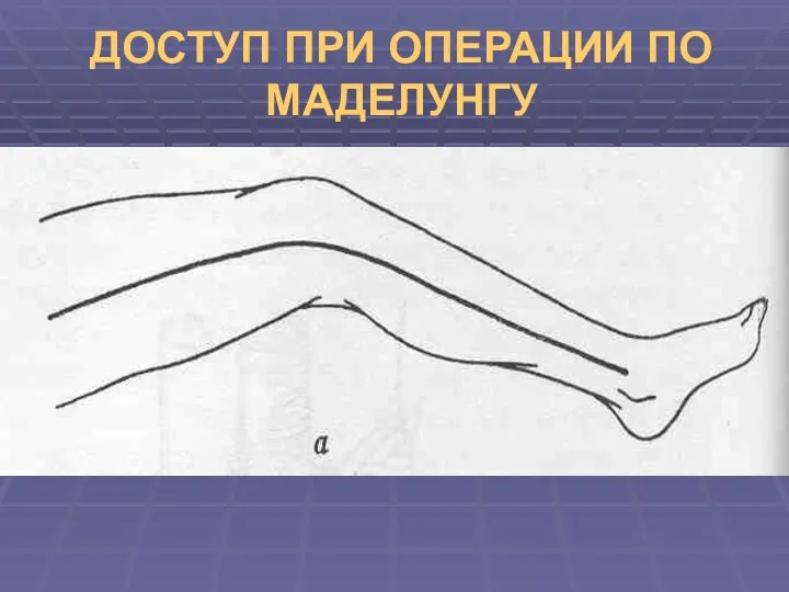 ДОСТУП ПРИ ОПЕРАЦИИ ПО МАДЕЛУНГУ