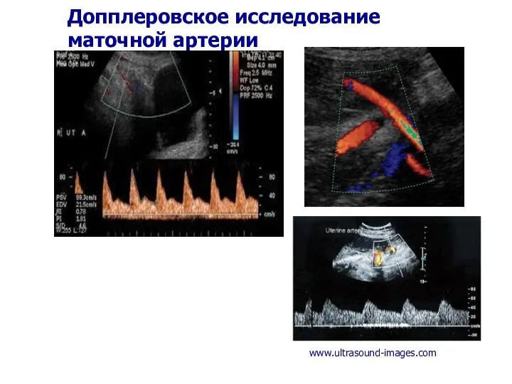 Допплеровское исследование маточной артерии www.ultrasound-images.com