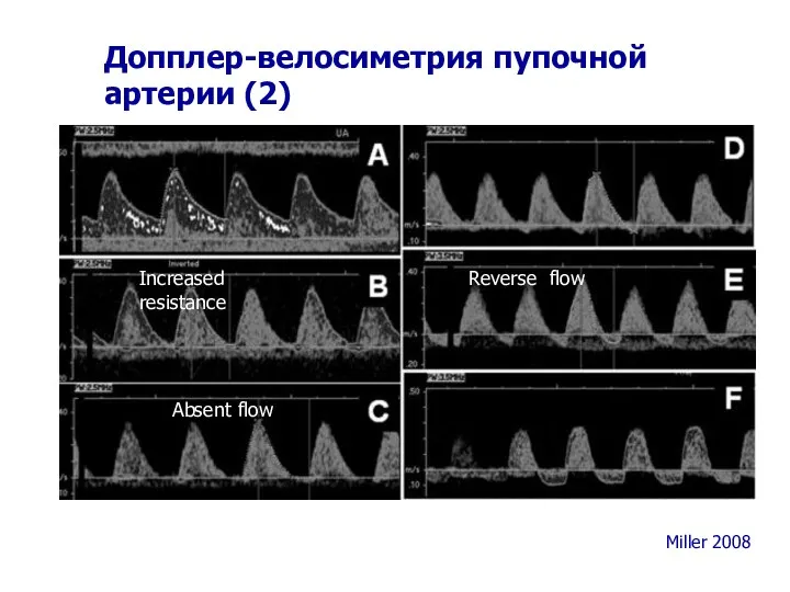 Допплер-велосиметрия пупочной артерии (2) Miller 2008 Absent flow Reverse flow Increased resistance