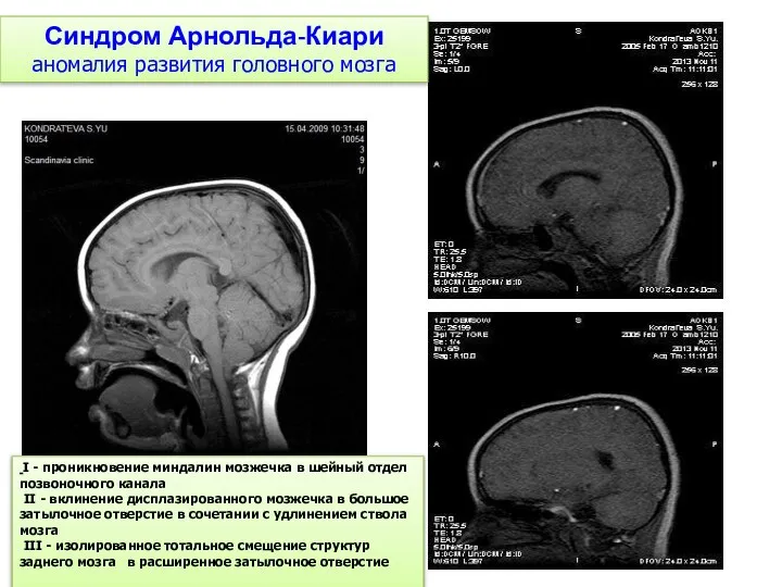 Синдром Арнольда-Киари аномалия развития головного мозга I - проникновение миндалин мозжечка