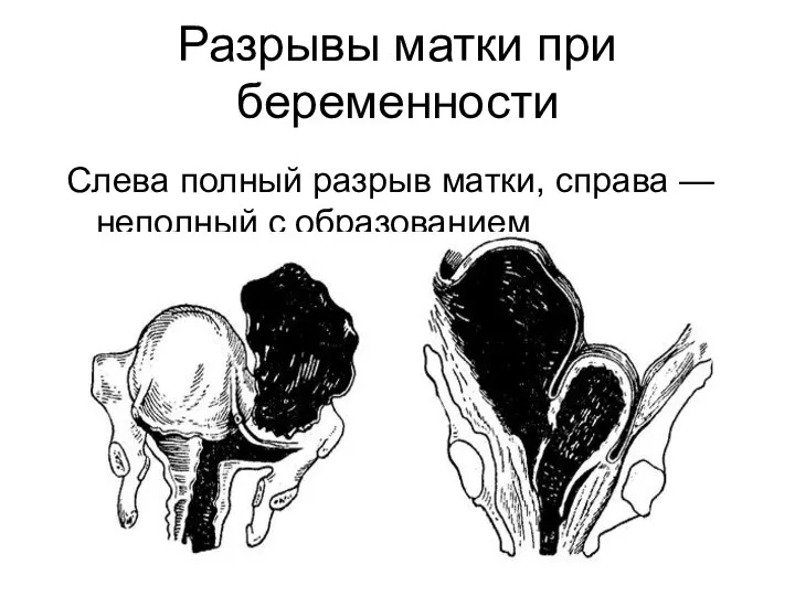 Разрывы матки при беременности Слева полный разрыв матки, справа — неполный с образованием забрюшинной гематомы.