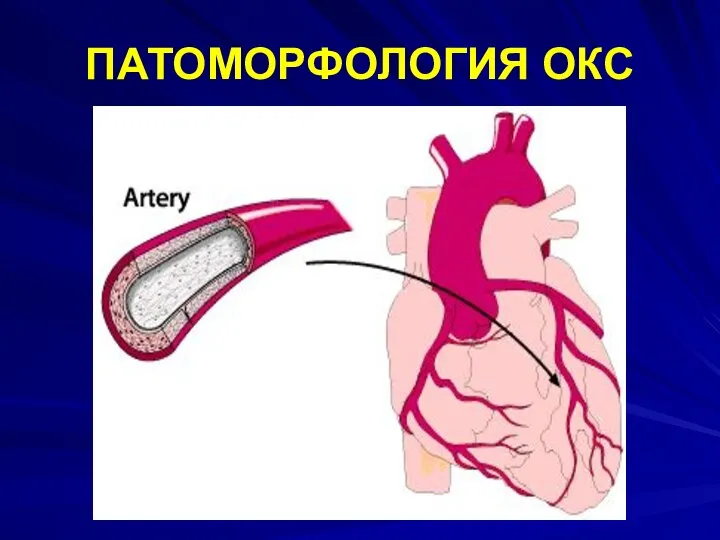 ПАТОМОРФОЛОГИЯ ОКС