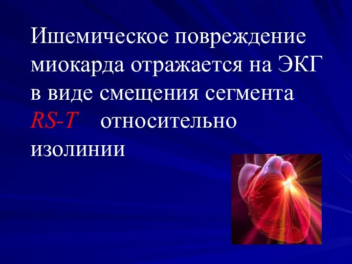 Ишемическое повреждение миокарда отражается на ЭКГ в виде смещения сегмента RS-T относительно изолинии