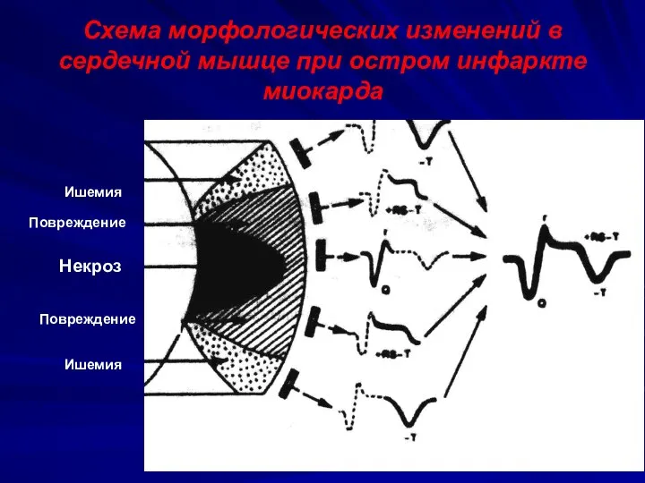 Схема морфологических изменений в сердечной мышце при остром инфаркте миокарда Ишемия Повреждение Некроз Повреждение Ишемия