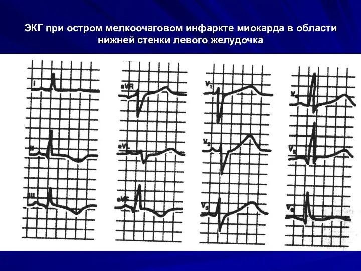 ЭКГ при остром мелкоочаговом инфаркте миокарда в области нижней стенки левого желудочка