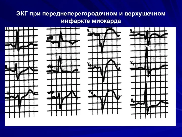 ЭКГ при переднеперегородочном и верхушечном инфаркте миокарда