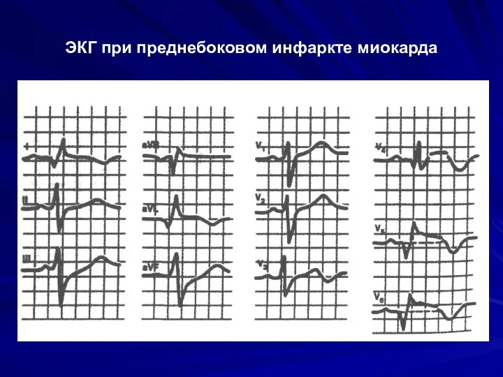 ЭКГ при преднебоковом инфаркте миокарда