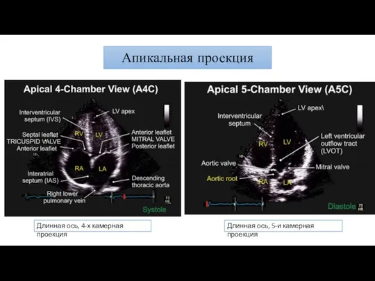 Апикальная проекция Длинная ось, 4-х камерная проекция Длинная ось, 5-и камерная проекция