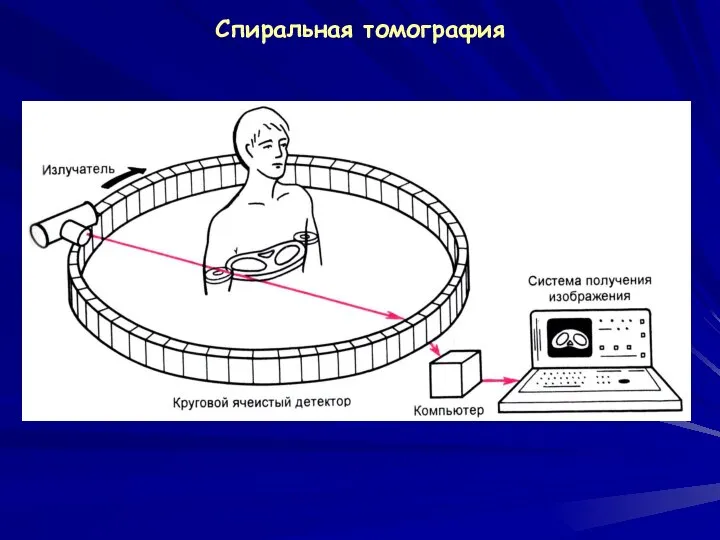 Спиральная томография