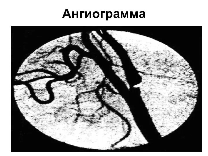 Ангиограмма