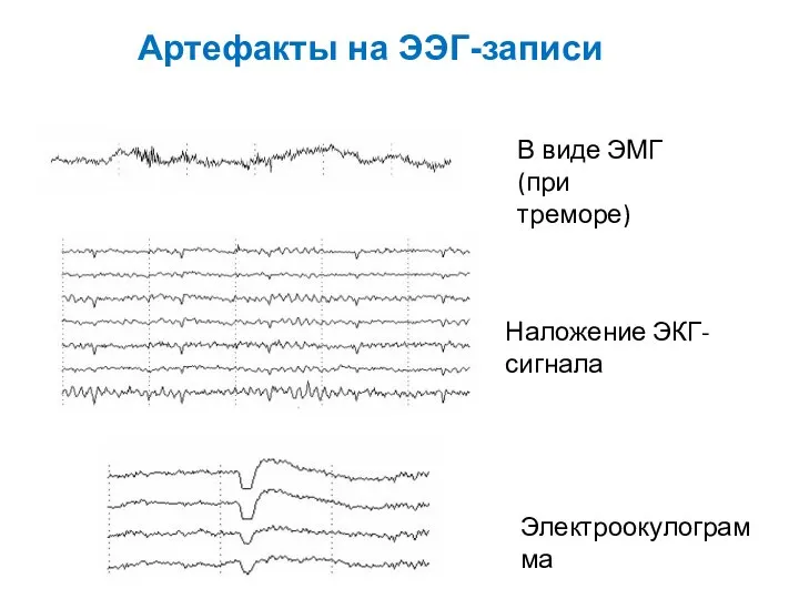 Артефакты на ЭЭГ-записи В виде ЭМГ (при треморе) Наложение ЭКГ-сигнала Электроокулограмма