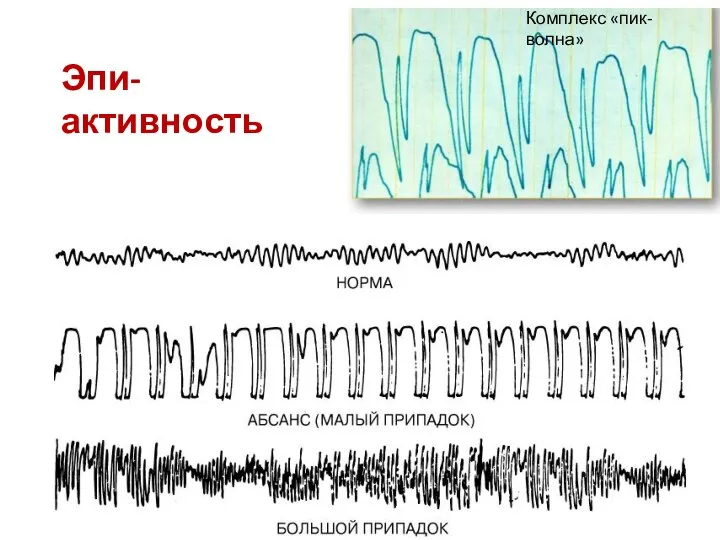 Эпи-активность Комплекс «пик-волна»