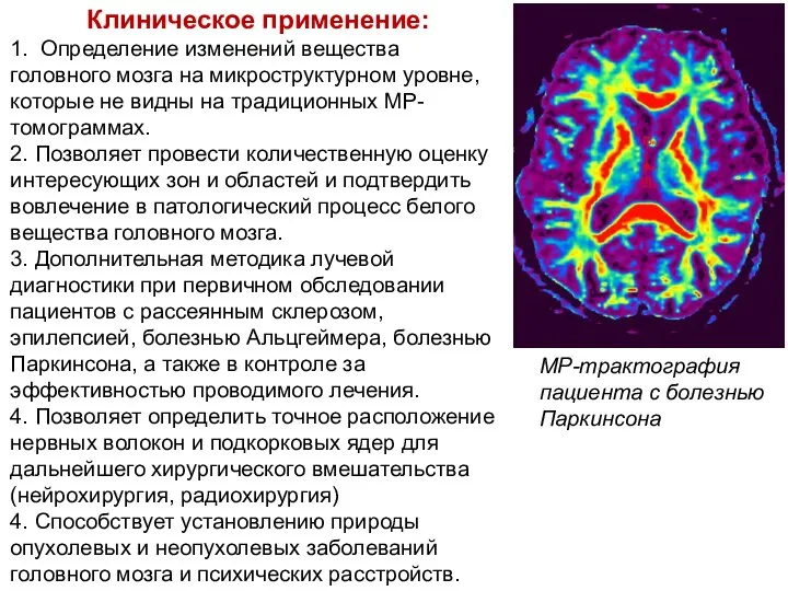 МР-трактография пациента с болезнью Паркинсона Клиническое применение: 1. Определение изменений вещества