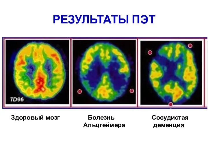 РЕЗУЛЬТАТЫ ПЭТ Здоровый мозг Болезнь Сосудистая Альцгеймера деменция