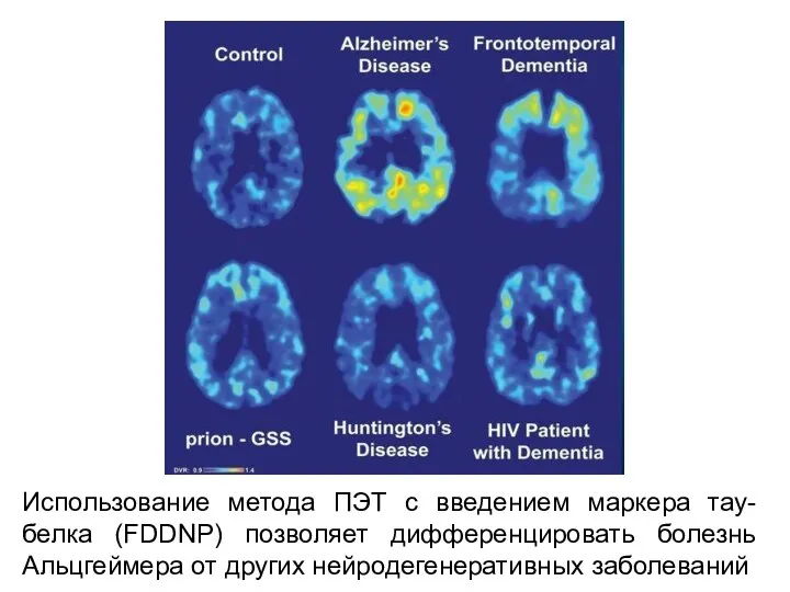 Использование метода ПЭТ с введением маркера тау-белка (FDDNP) позволяет дифференцировать болезнь Альцгеймера от других нейродегенеративных заболеваний