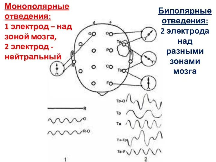 Монополярные отведения: 1 электрод – над зоной мозга, 2 электрод -