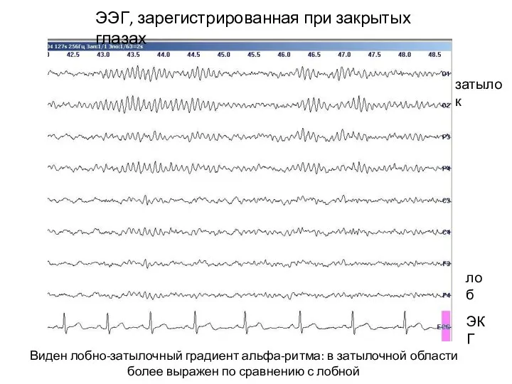 затылок лоб ЭКГ ЭЭГ, зарегистрированная при закрытых глазах Виден лобно-затылочный градиент