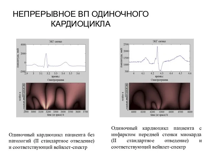 НЕПРЕРЫВНОЕ ВП ОДИНОЧНОГО КАРДИОЦИКЛА Одиночный кардиоцикл пациента без патологий (II стандартное