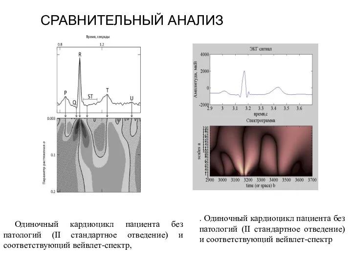 СРАВНИТЕЛЬНЫЙ АНАЛИЗ Одиночный кардиоцикл пациента без патологий (II стандартное отведение) и