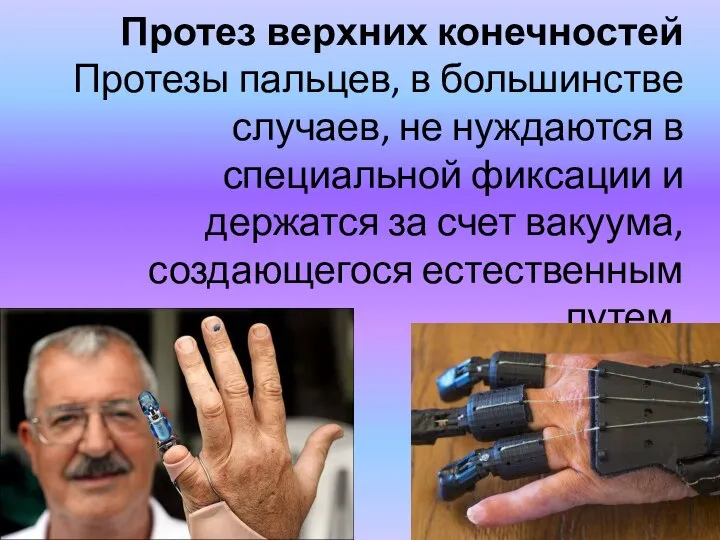 Протез верхних конечностей Протезы пальцев, в большинстве случаев, не нуждаются в