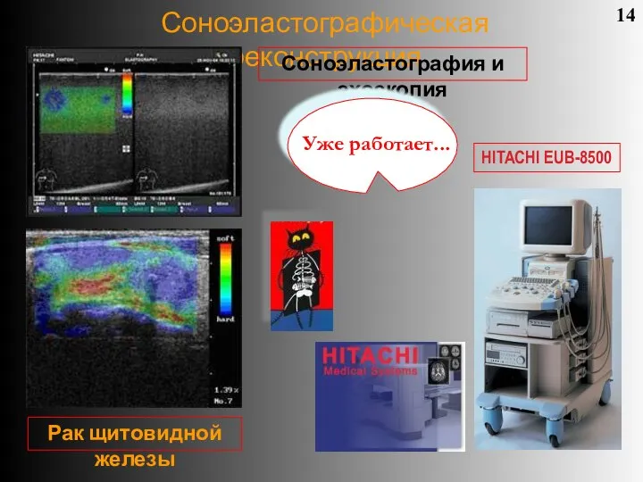 Соноэластографическая реконструкция 14 Соноэластография и эхоскопия Рак щитовидной железы