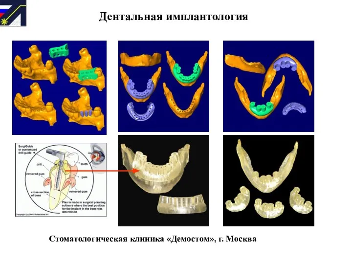 Дентальная имплантология Стоматологическая клиника «Демостом», г. Москва ЛАЗЕРНАЯ СТЕРЕОЛИТОГРАФИЯ